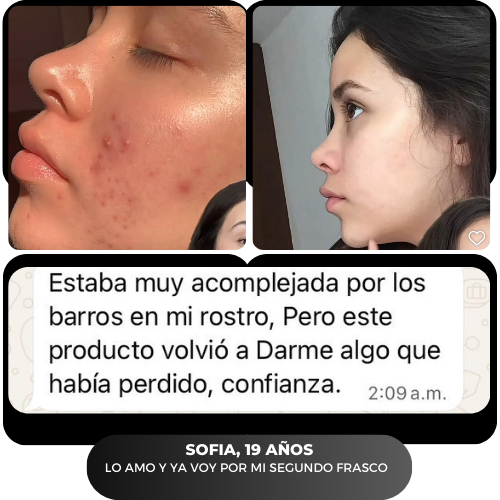 ACNÉ SECUELAS DE ACNE